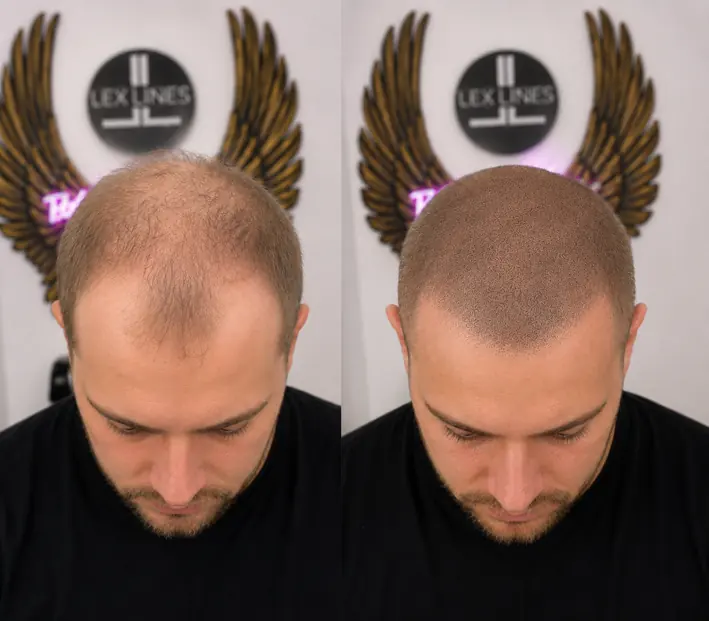 Haarpigmentierung Männer, Oberkopf Vorher und Nachher, Lex Lines