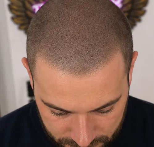 Haarpigmentierung Männer, kurze Buzzcut-Optik nach der Behandlung, Lex Lines