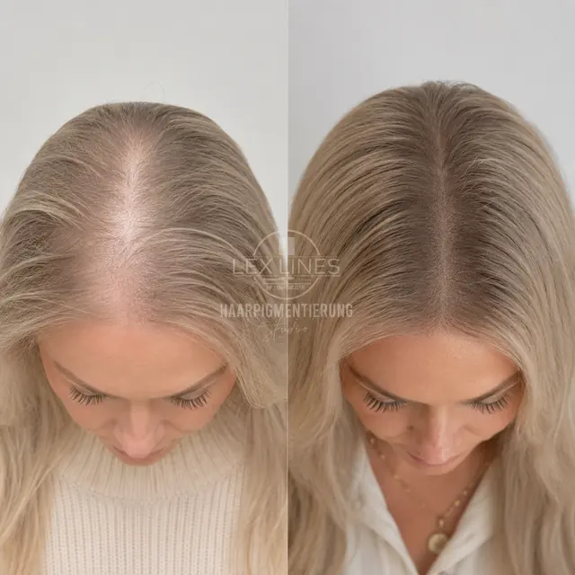 Optische Haarverdichtung für Frauen, Scheitelbereich, Lex Lines