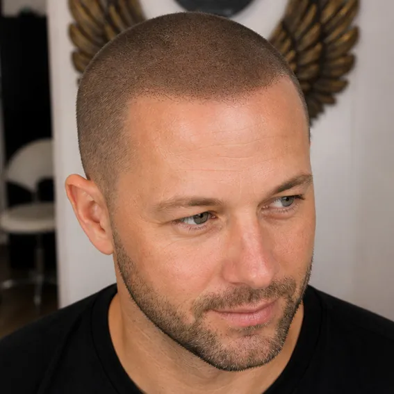 Haarpigmentierung Männer, definierte Haarlinie nach der Behandlung, Lex Lines
