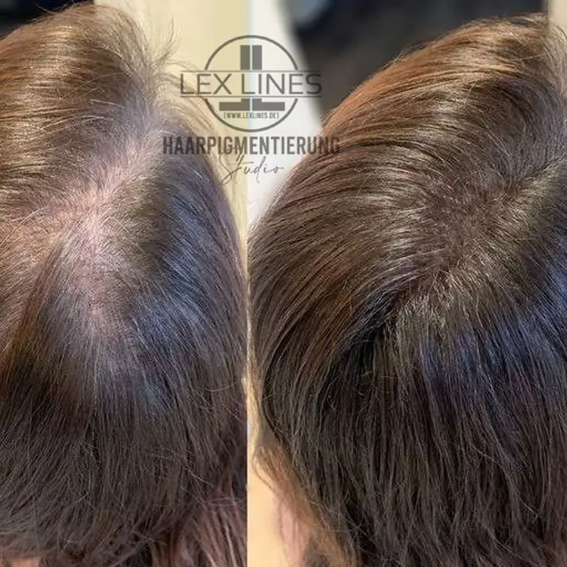 Haarverdichtung Frauen, Ergebnisdetail, Lex Lines