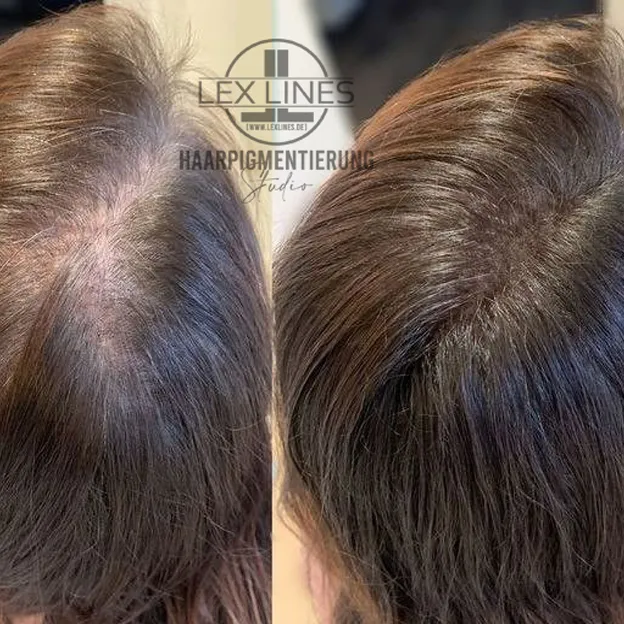 Haarverdichtung Frauen, Ergebnisdetail, Lex Lines
