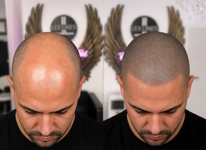 Haarpigmentierung Männer, Glatze Vorher und Nachher, Lex Lines