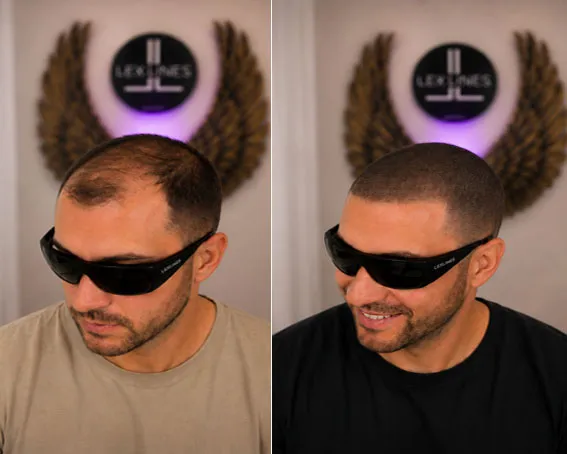 Haarpigmentierung Männer, Haarlinie Vorher und Nachher, Lex Lines