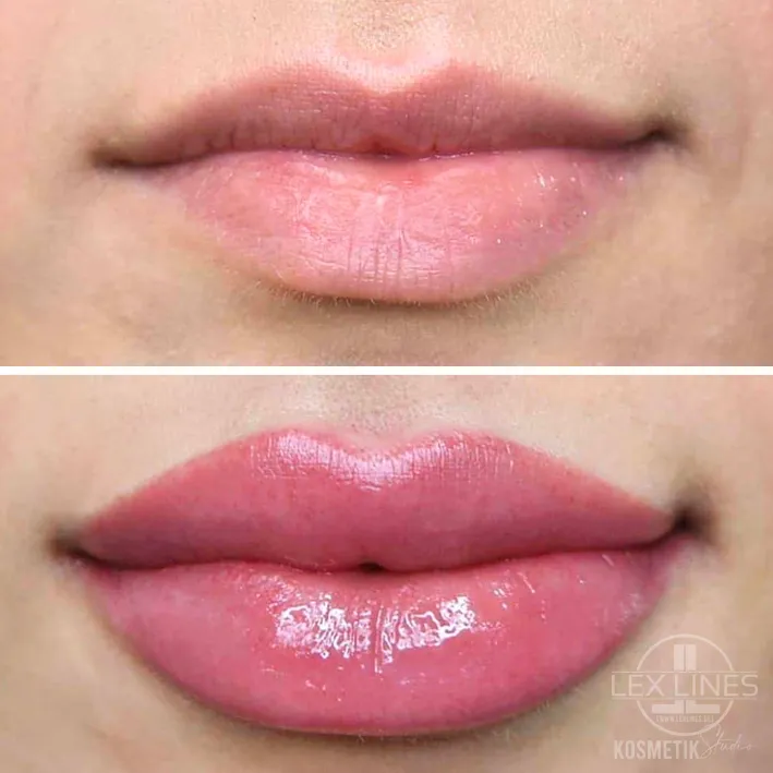 Lippenpigmentierung Vorher und Nachher, Lex Lines